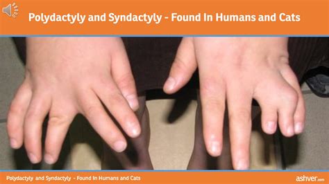 Polydactyly and Syndactyly - Found In Humans and Cats - YouTube