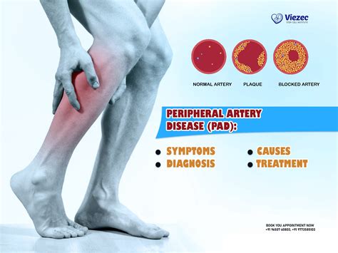 Peripheral Artery Disease: Symptoms, Causes, Diagnosis, Treatment