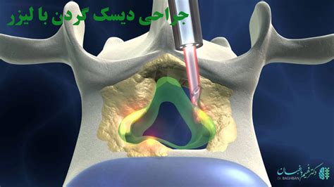 جراحی دیسک گردن و انواع روش های این عمل - دکتر فهیم باغبان