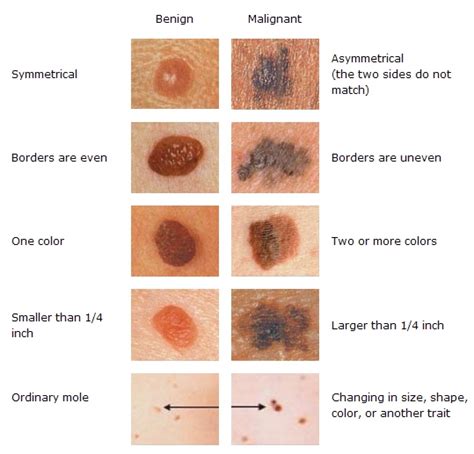 Vascular Skin Lesions Pictures - Ajor Png