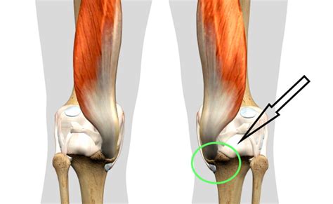 All You Need to Know About Low Hamstring Tendonitis - Sport Doctor London