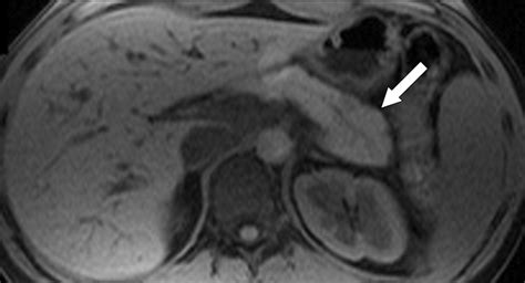 MRI of Pancreatitis and Its Complications: Part 2, Chronic Pancreatitis ...