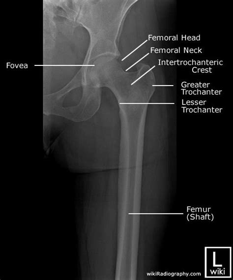 Femur Radiographic Anatomy | Radiology student, Diagnostic imaging ...