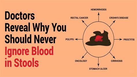 Doctors Reveal Why You Should Never Ignore Blood in Stools