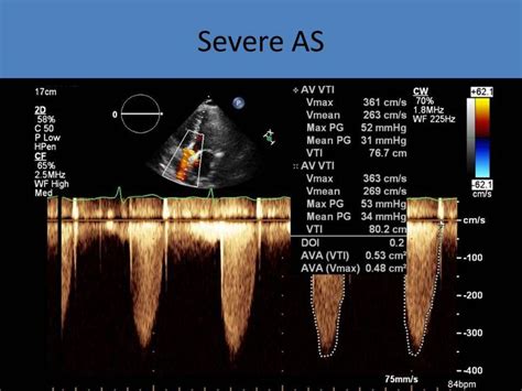 Valvular Abnormalities | Cardiac sonography, Diagnostic medical ...