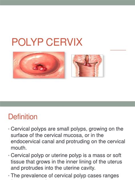 Polyp Cervix | PDF | Vagina | Uterus