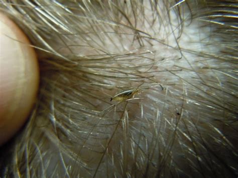 Lice Symptoms, Causes, Diagnosis and Treatment - Natural Health News