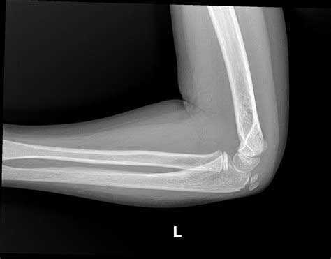 OrthoDx: Medial Epicondyle Fractures - Clinical Advisor