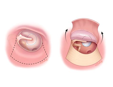 Congenital Cholesteatoma