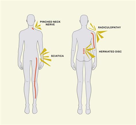 What is a Pinched Nerve? [Common Causes & Treatments]