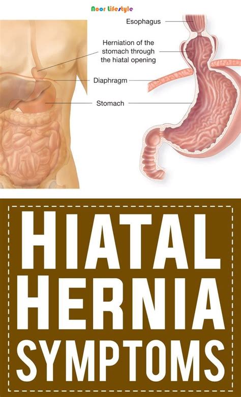 Pin on Diet for a Hiatal Hernia