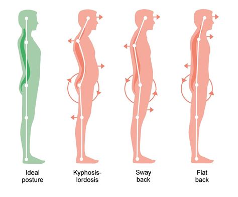 sway back posture exercises pdf - Caterina Simons