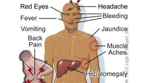 Yellow fever- Causes, Symptoms, Treatment, Diagnosis and Prevention ...