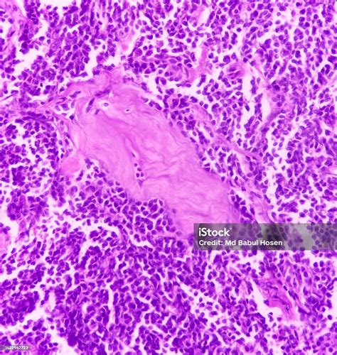 Supraclavicular Lymph Node Biopsy Microscopic Image Showing Benign ...