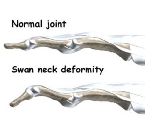 Swan Neck Deformity Splint Rings | JewelSplint