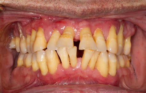 Gum disease symptoms and treatment - Cuckfield Dental