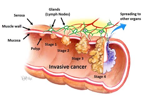 Bowel Cancer Screening | Colorectal Surgeons Sydney