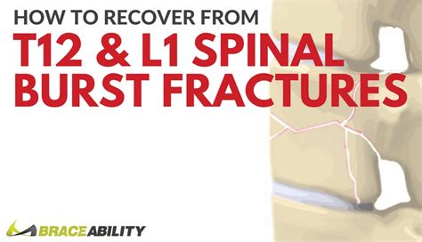 How Can I Treat a T12 or L1 Thoracic Spinal Burst Fracture?