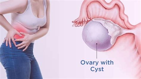 Ovarian Cyst Removal Surgery: A Comprehensive Guide | by Gayatri ...