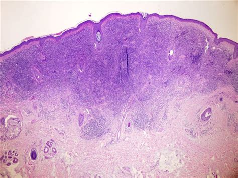 Pathology Outlines - Halo nevus