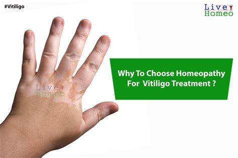 Vitiligo Treatment | Live Homeo