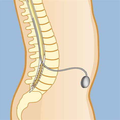 Surgery for Spasticity | Weill Cornell Brain and Spine Center