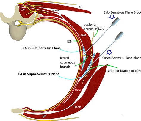 Efficacy of Ultrasound-Guided Serratus Anterior Plane Block for ...