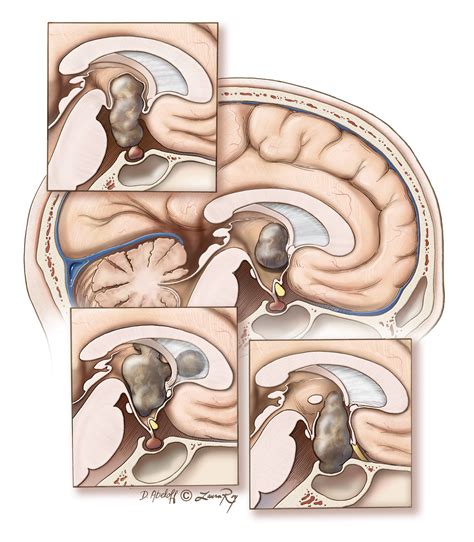 Craniopharyngioma (Transcranial Approach) | The Neurosurgical Atlas