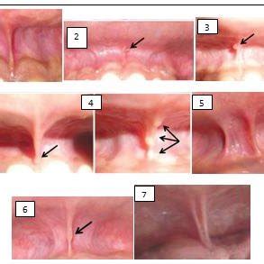 Sewerin's morphological types of maxillary labial frenum. Simple ...