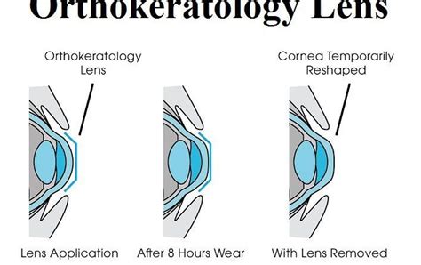 What is Orthokeratology?