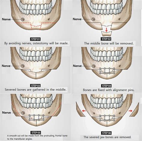 ID Hospital Korea: Mandible jaw reduction surgery with diamond-shaped ...