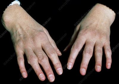 Hands of a patient with rheumatoid arthritis - Stock Image - M110/0334 ...