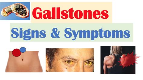 Gallstones Signs & Symptoms, Why They Occur | Cholecystitis ...