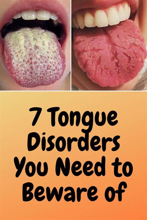 7 Tongue Disorders You Need to Beware of