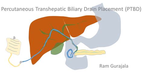 Percutaneous Transhepatic biliary drain placement (PTBD) | IR 4 U