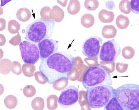 Symptoms Of Chronic Lymphocytic Leukemia | Chronic Lymphocytic Leukemia ...