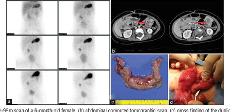 Figure 1 from Intestinal Duplication Cyst Misdiagnosed as Meckel's ...