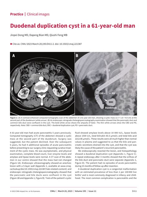 (PDF) Duodenal duplication cyst in a 61-year-old man