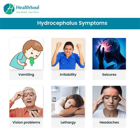 hydrocephalus symptoms – hydrocephalus in adults – Empiretory