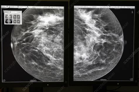 mammography result - Stock Image - C015/2205 - Science Photo Library