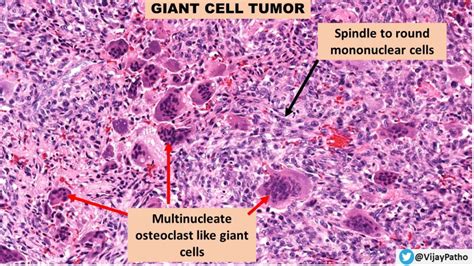 GIANT CELL TUMOR - BONE - Pathology Made Simple