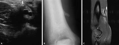 A, Ultrasonography in short axis shows the bone surface with acoustic ...