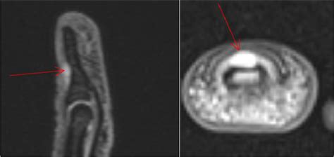 Finger MRI revealing a subungual glomus tumor (arrow) | Download ...