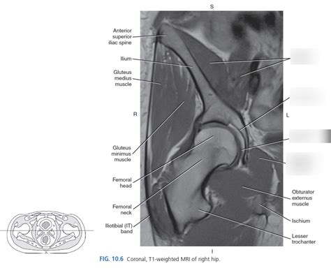 Coronal MRI of right hip Diagram | Quizlet