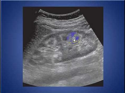 Medullary Nephrocalcinosis Ultrasound