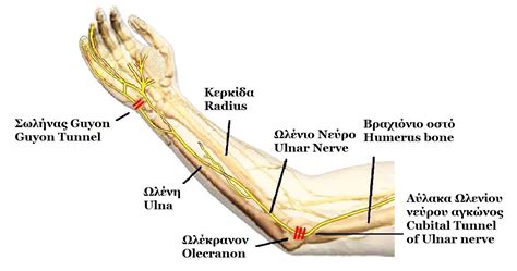 Ulnar nerve entrapment - Wikipedia