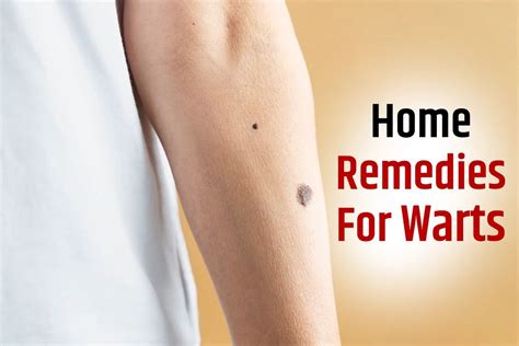 Wart Removal: 5 Effective Natural Remedies To Treat Warts at Home