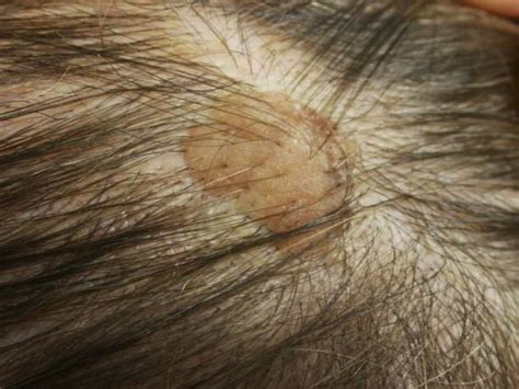 Seborrheic Keratosis Wart on Scalp Pictures | Getty Images