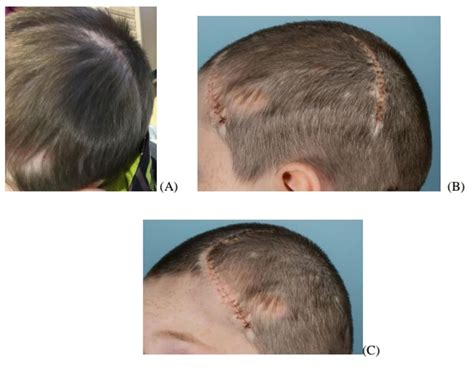 Deformation of cranioplasty titanium mesh in a paediatric patient ...