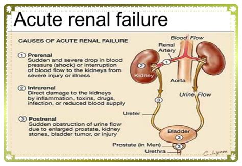 Acute renal failure - Sure Developers Team